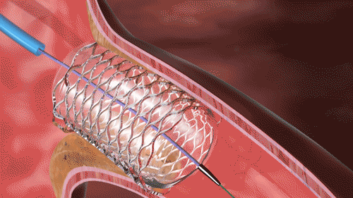What is Angioplasty? | Chesapeake Regional Healthcare